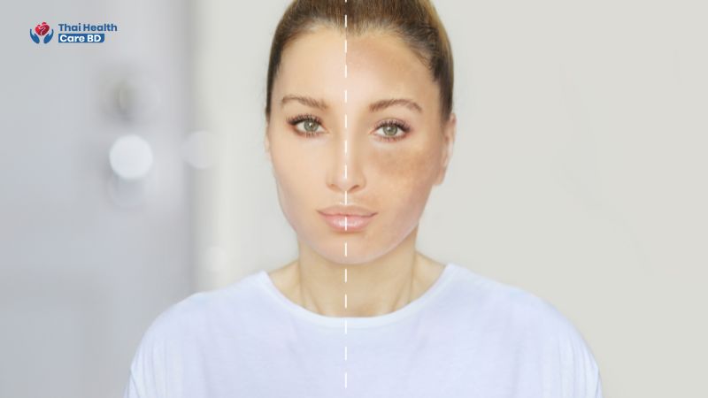 Skin Whitening Treatment in Bangkok, Thailand